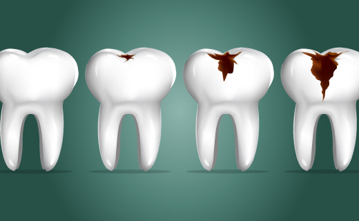 دندانهای پوسیده از عوارض بولیمیا نروزا فرم پاکسازی است